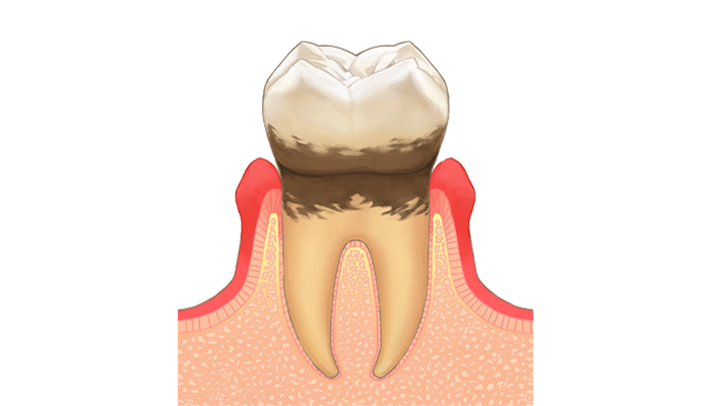 軽度歯周病